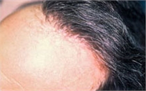 After picture of Hair Transplants