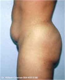 Before Liposuction Treatment of the Abdomen