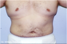 Liposuction Treatment of Chest & Flanks Before
