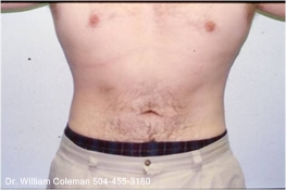Liposuction Treatment of Chest & Flanks After