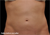 Coolsculpting after image