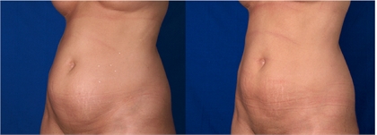 Ultrashape Before and after image