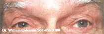 After Eyelid Surgery New Orleans