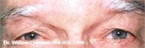 Before Eyelid Surgery New Orleans