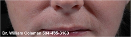 Before Fillers are used on smile lines