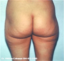 After Buttocks Liposuction New Orleans