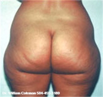 Before Buttocks Liposuction New Orleans