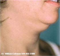 before neck Liposuction New Orleans