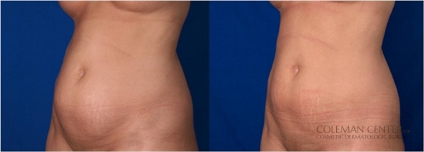 Ultrashape before and after image