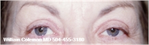 After Eyelid Surgery New Orleans