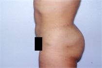 After Abdominal Liposuction in New Orleans