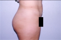 After Abdominal Liposuction New Orleans