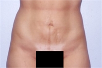 After Liposuction of the Hips
