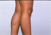 After Lower Leg Liposuction New Orleans