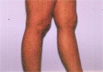 Before Lower Leg Liposuction New Orleans